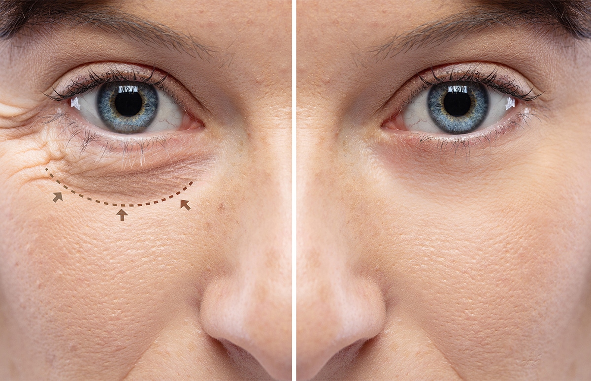 ¿Pensando en hacerte una blefaroplastia? ¿Podría estar cubierta por tu seguro médico? Te lo contamos.