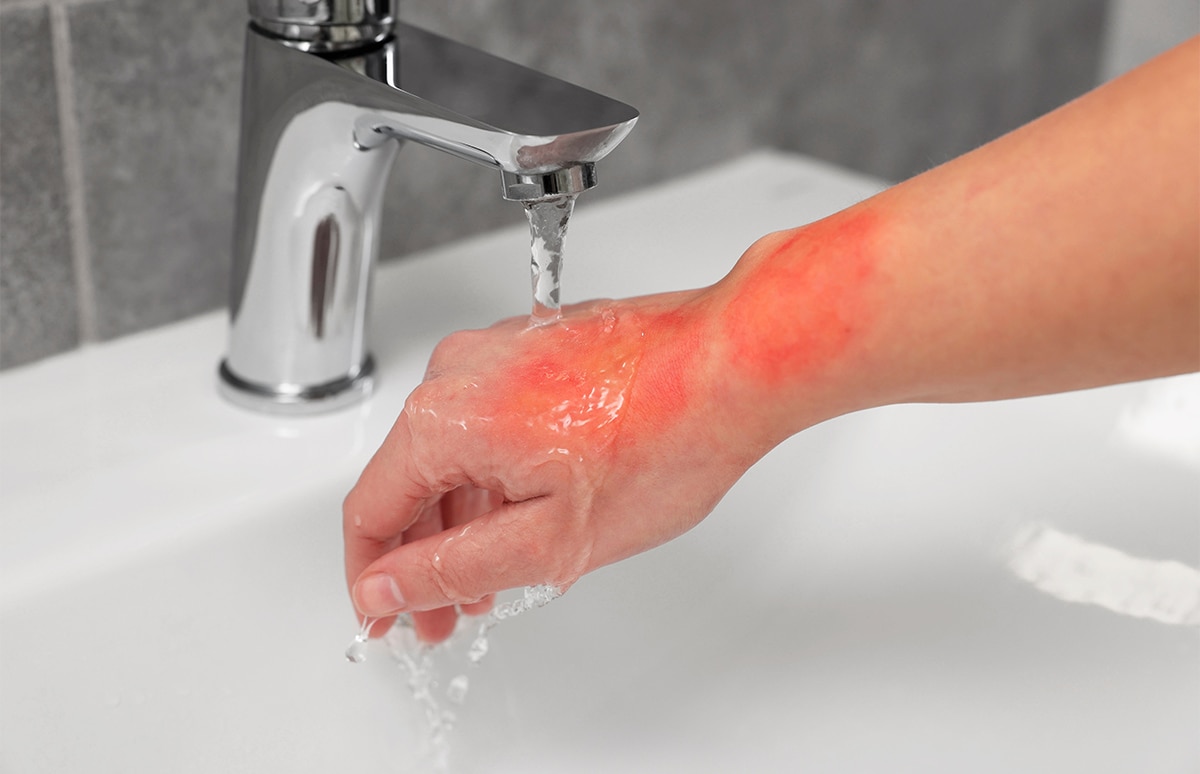 Mano con una quemadura visible siendo enfriada bajo un chorro de agua corriente, una de las medidas recomendadas como primeros auxilios ante quemaduras leves