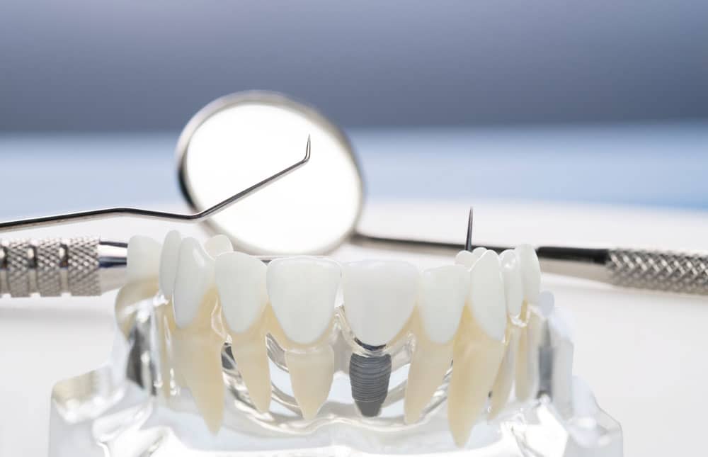 Ventajas de los implantes dentales