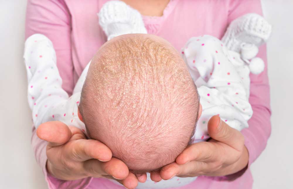 Cómo se trata la costra láctea de los bebés